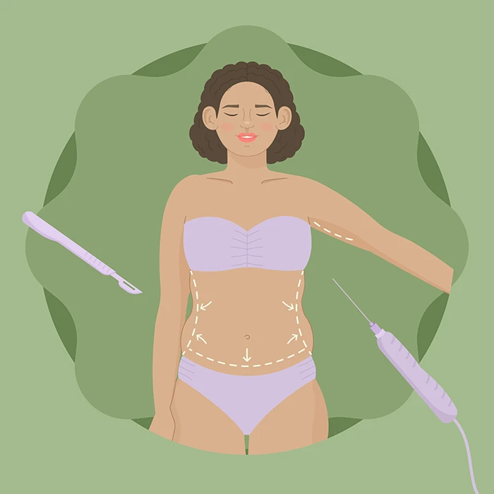 An illustration showing a woman with markings on her body with a cannula on the side