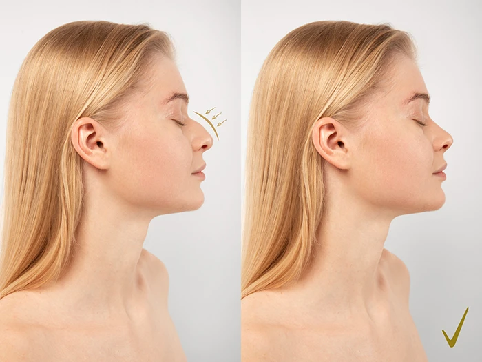A before and after picture of a woman after a nose job