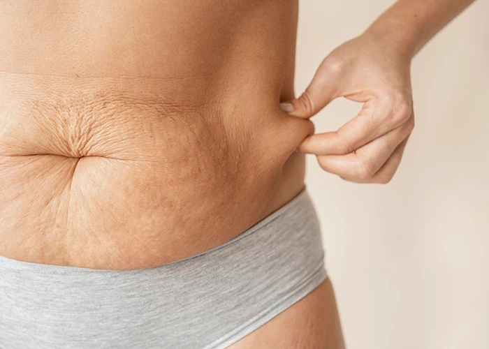 A woman holding her tummy sagging skin