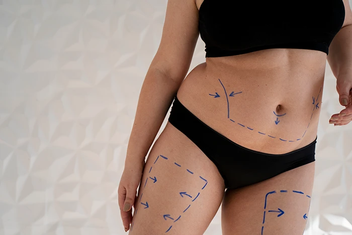A woman with markings on her belly and thighs
