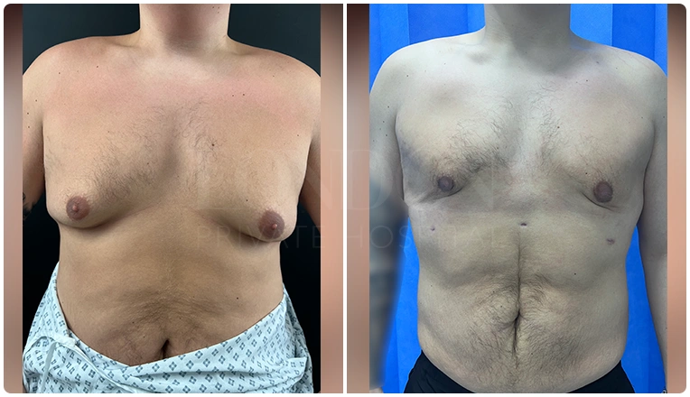 gynecomastia-before-and-after-patient