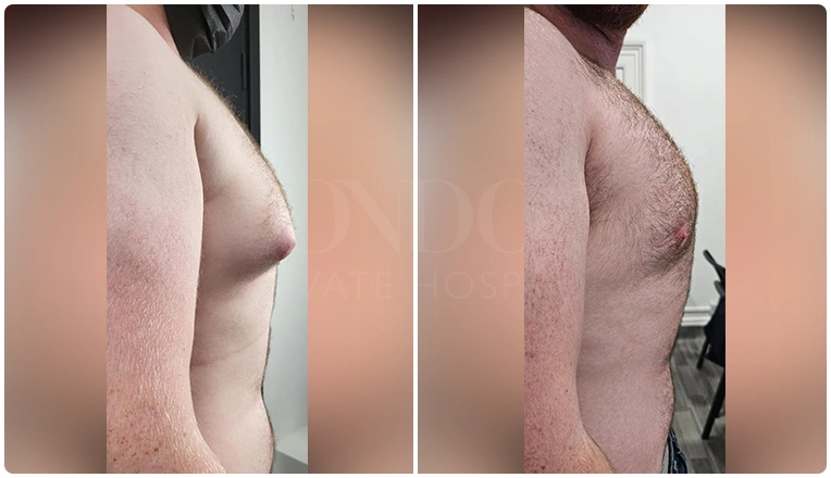 gynecomastia-before-and-after-patient