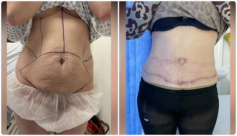 tummy-tuck-before-and-after-result-patient