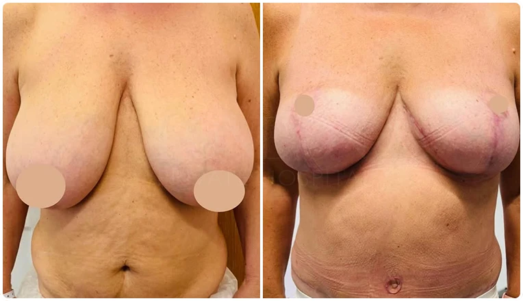 abdominoplasty combines with vaser liposuction and breast reduction result