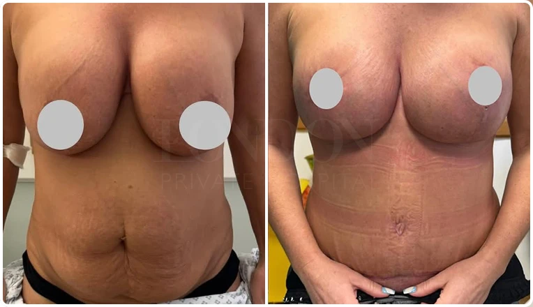 breast augmentation, lift and tummy tuck result