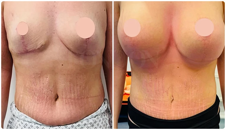 breast-uplift-and-new-breast-augmentation-plus-tummy-tuck-vaser-liposuction-result
