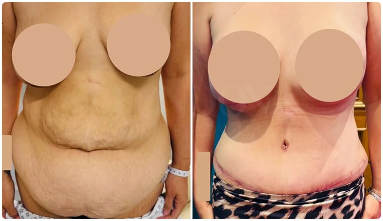 full tummy tuck and liposuction result
