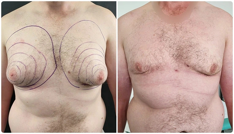 gynecomastia-before-and-after-patient