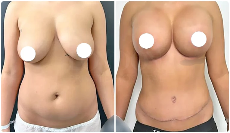 mummy makeover with tummy tuck and breast augmentation result