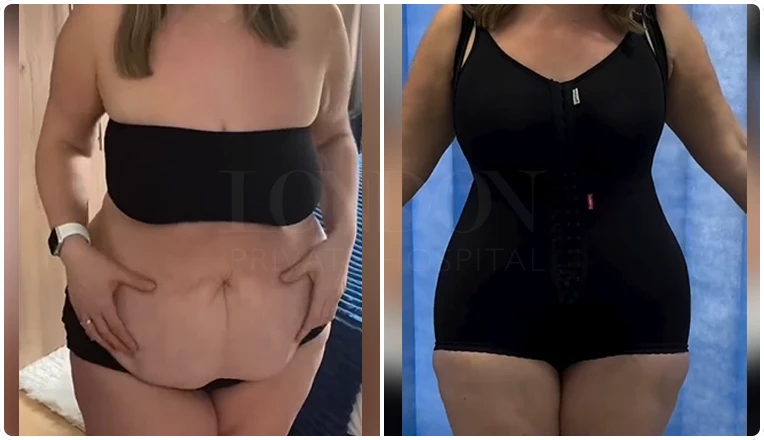 mummy-makeover-with-tummy-tuck-vaser-lipo-and-breast-augmentation-result