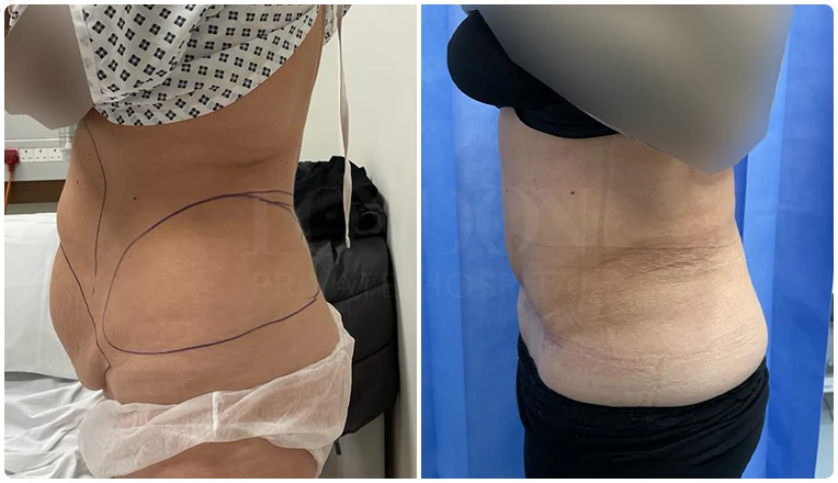 tummy-tuck-before-and-after