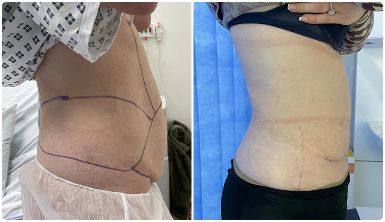 tummy-tuck-before-and-after-result