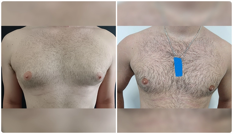 vaser-liposuction-and-gland-excision-for-gynecomastia-before-and-after-result