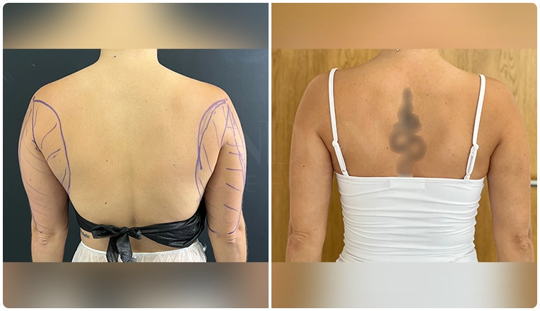 vaser-liposuction-to-upper-arms-and-upper-outer-back-result