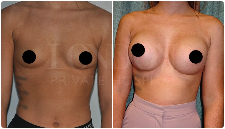 breast augmentation before and after patient-7