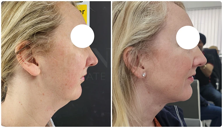 facial vaser liposuction before and after patient -3