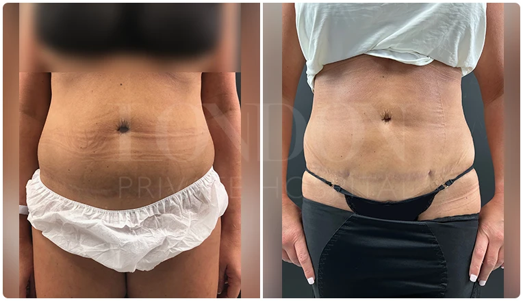 stomach vaser liposuction before and after-1