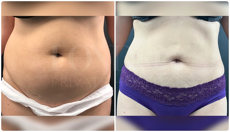stomach vaser liposuction before and after