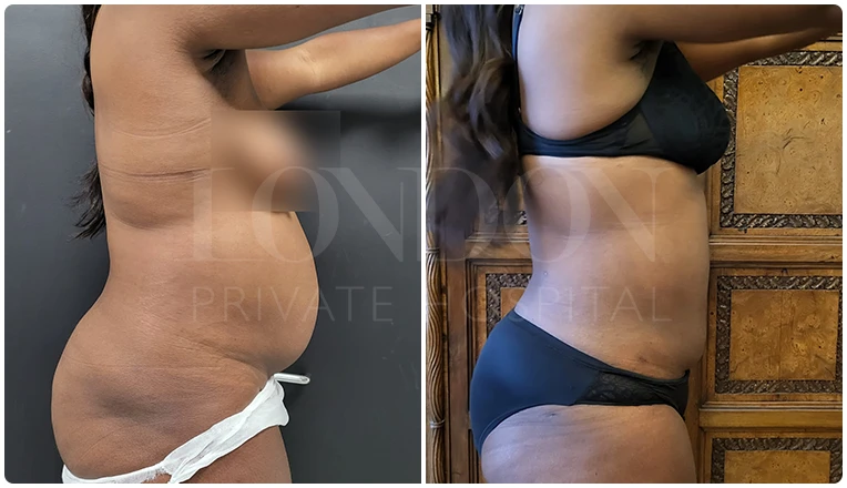 vaser lipo female abs before and after patient-2-v1