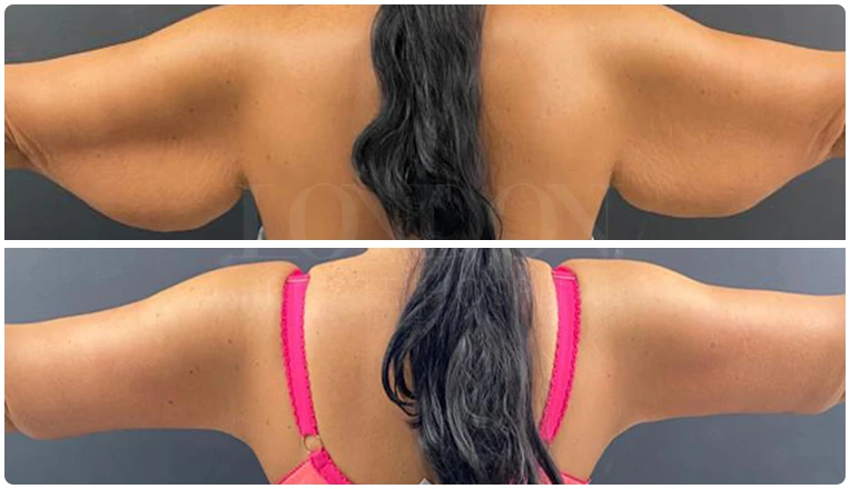 vaser lipo on arms before and after patient-1-v1