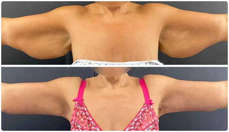 vaser lipo on arms before and after patient-1