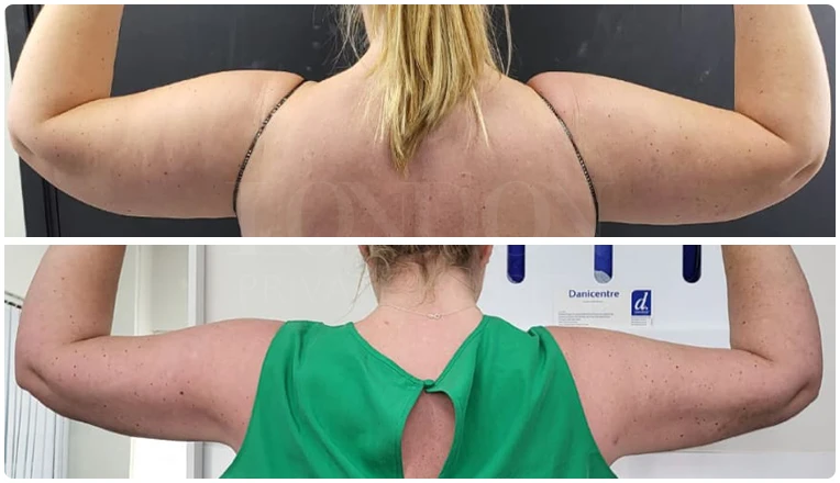 vaser lipo on arms before and after patient-2-v1