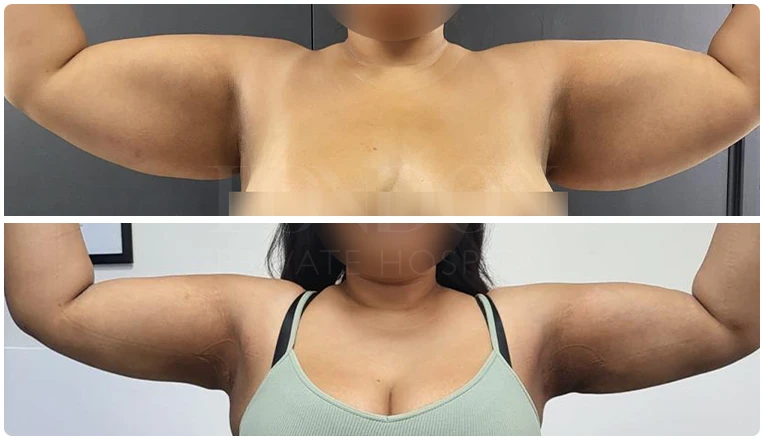 vaser lipo on arms before and after patient-3