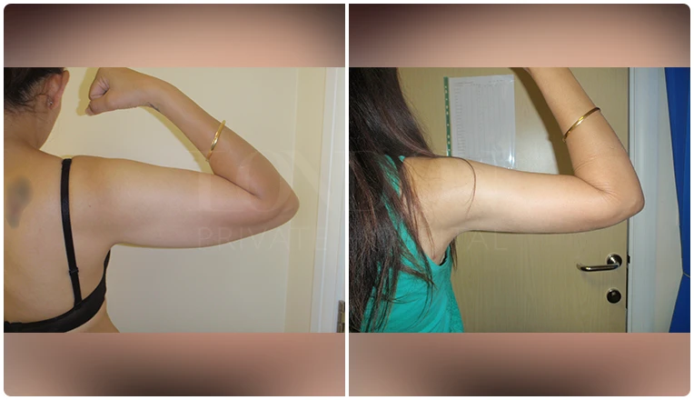 vaser lipo on arms before and after patient-v3