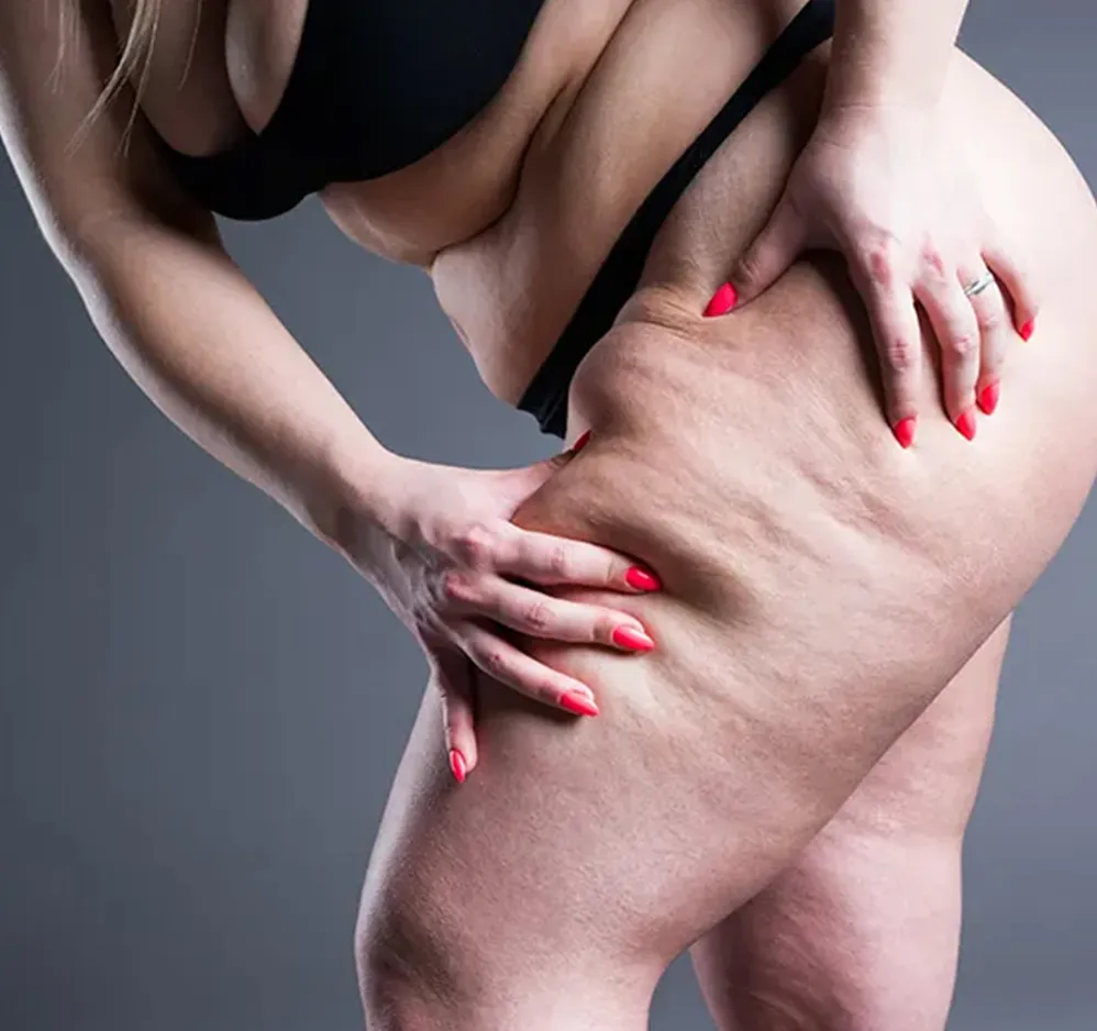 lipoedema