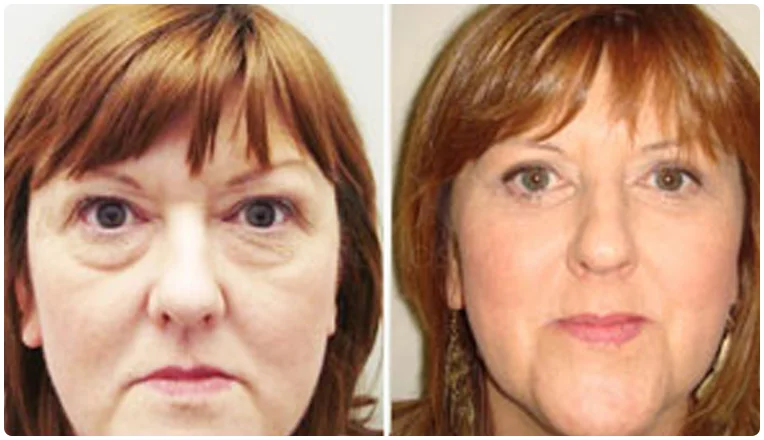 blepharoplasty before and after result patient - 9