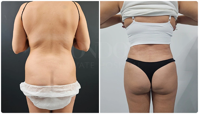 back vaser liposuction before and after patient result-11